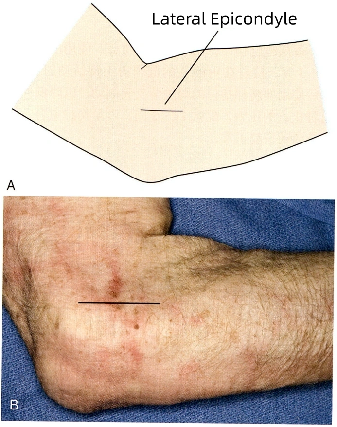 Degenerated tissue at the extensor carpi radialis brevis insertion.webp