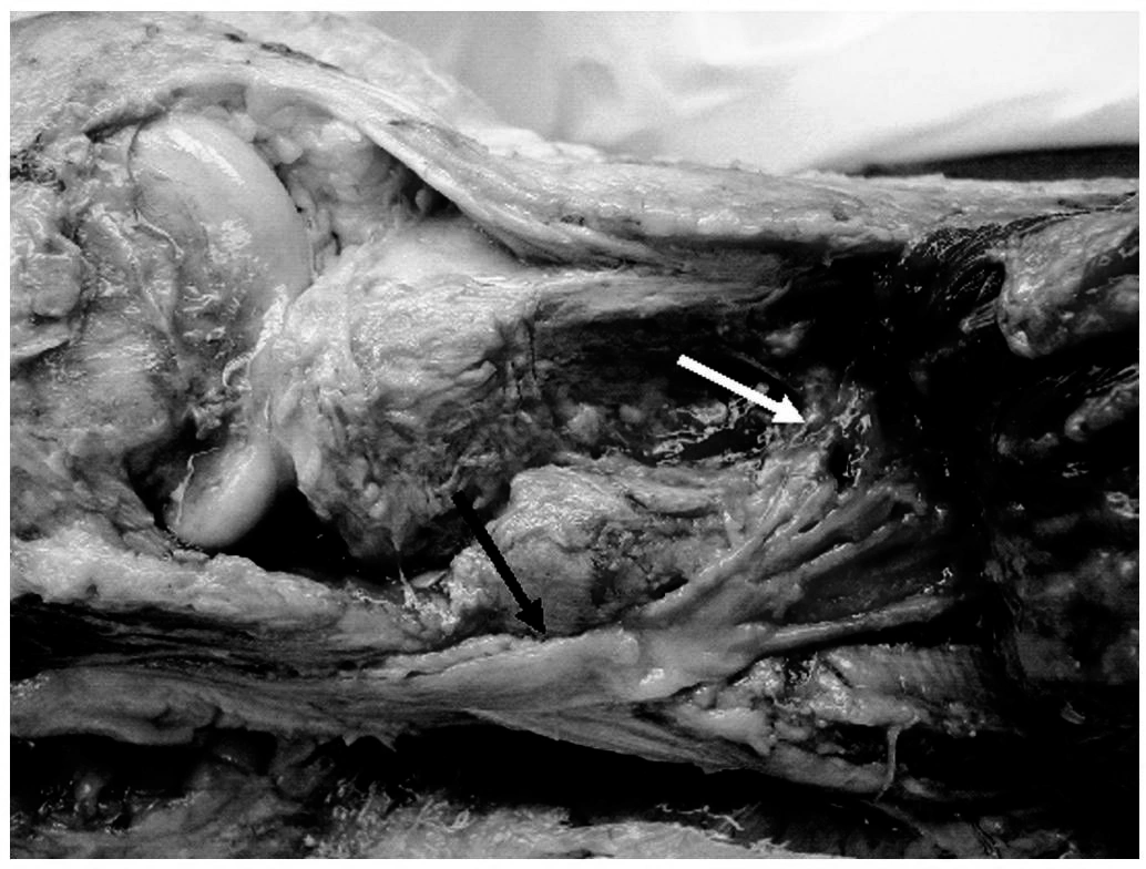 Common peroneal nerve near the proximal tibia.webp