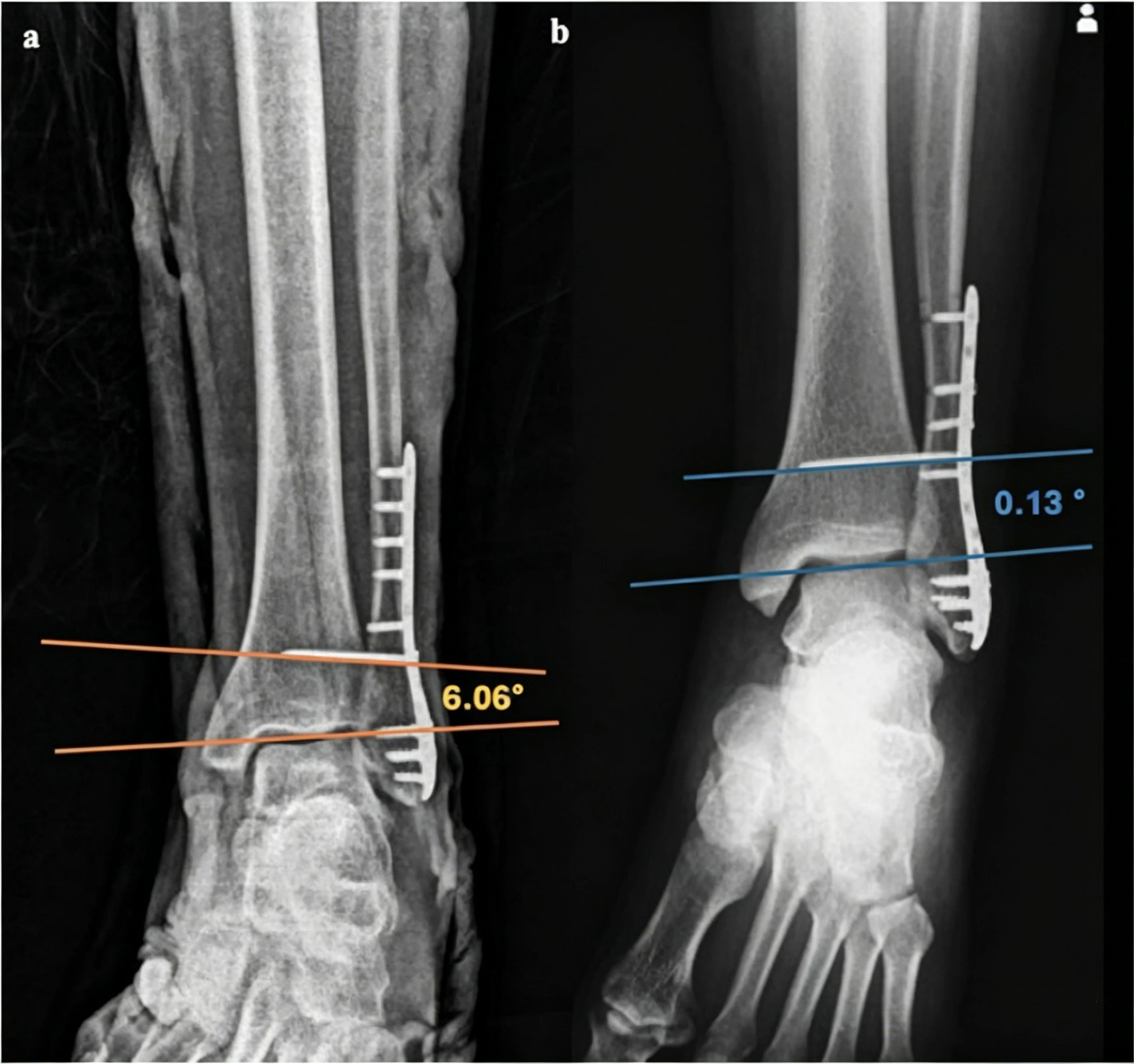 X-ray image of fibula.webp